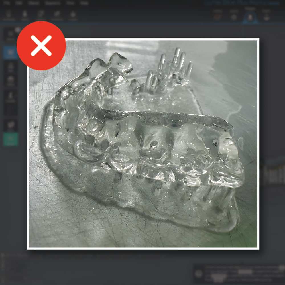 Failed dental model due to poor support strategy