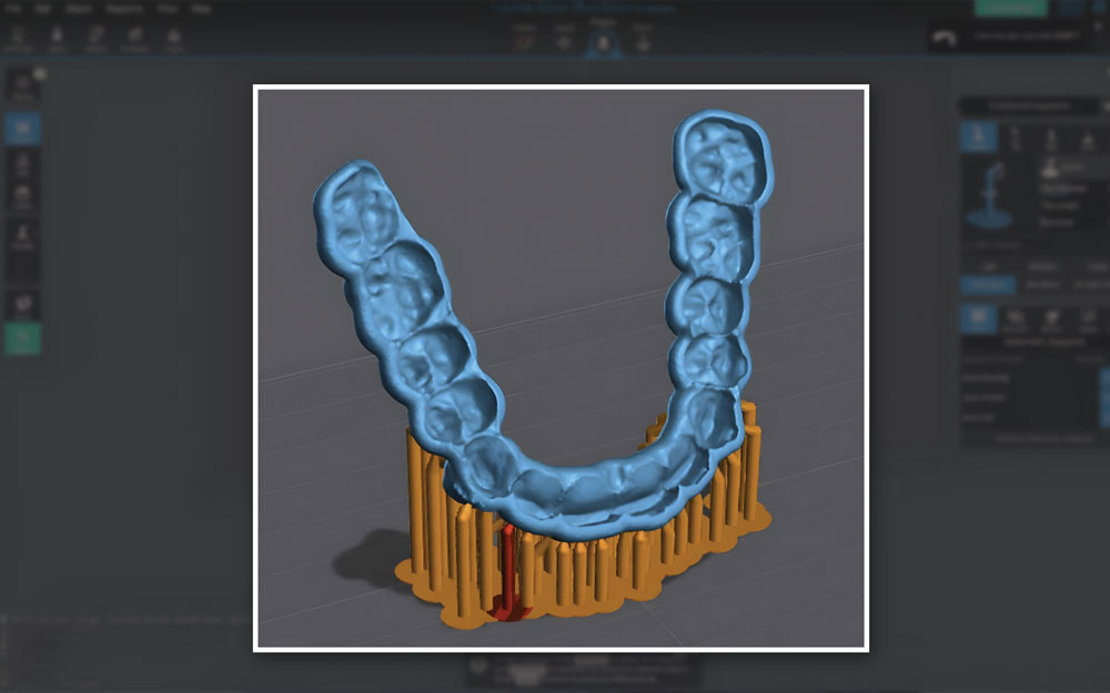Dental splint positioned and supported in slicer software, angled from the build plate