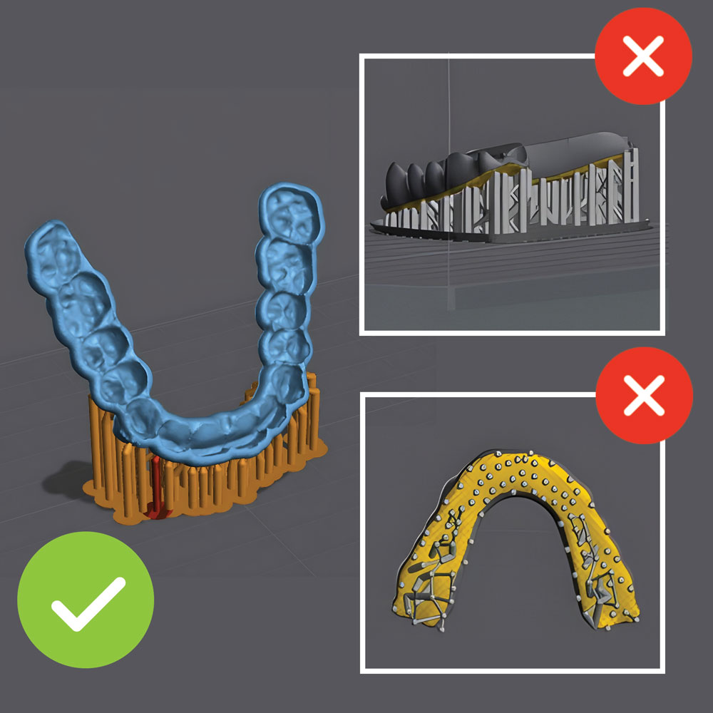 Side by side comparison showing incorrect and correct support placement on dental appliances